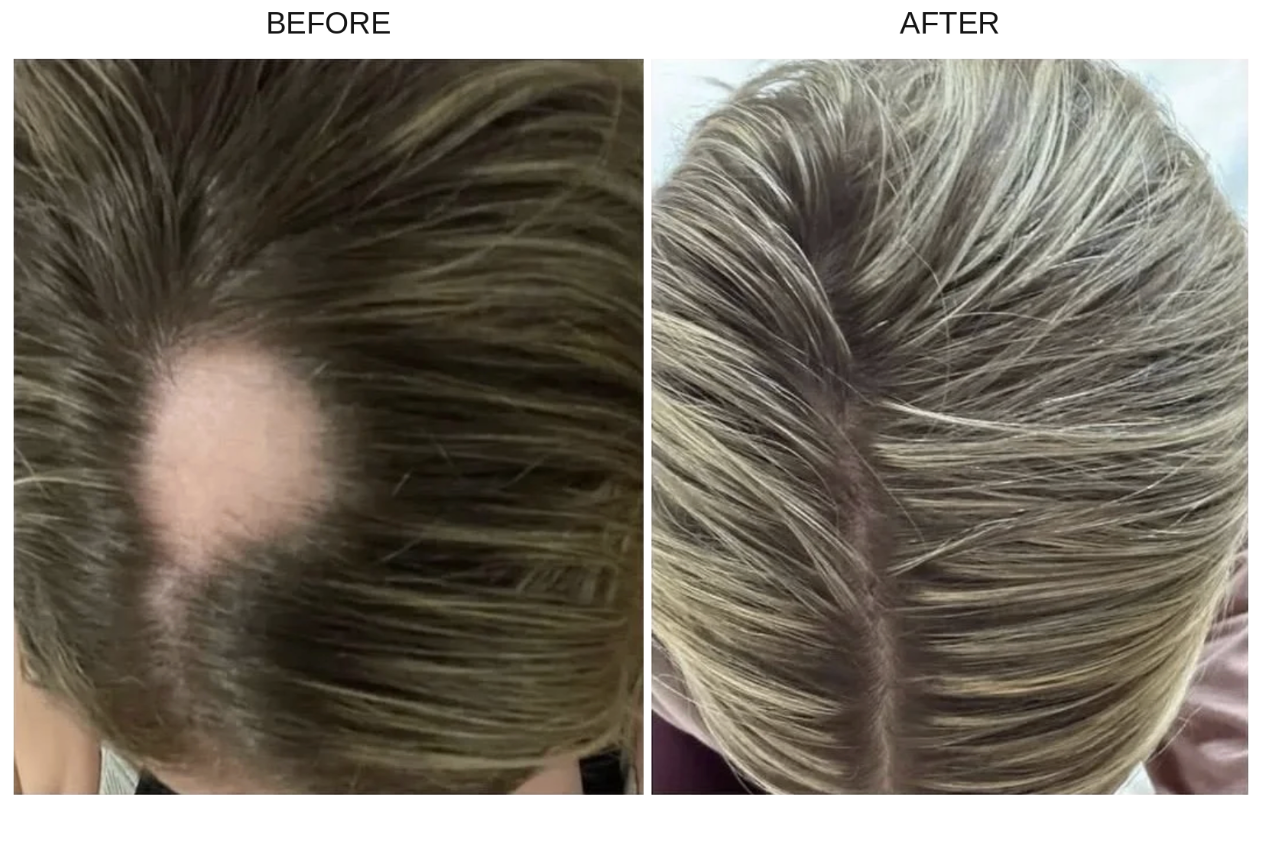 A side-by-side before and after comparison of a person's scalp from above after using The Nutrient Co Banging Beauty Supplement showing hair thinning and receding on the left ('BEFORE') and fuller, denser hair on the right ('AFTER').