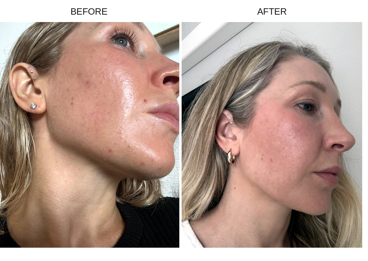 Before and after side-by-side comparison of a woman's face showing skin improvement after using The Nutrient Co Banging Beauty Supplement