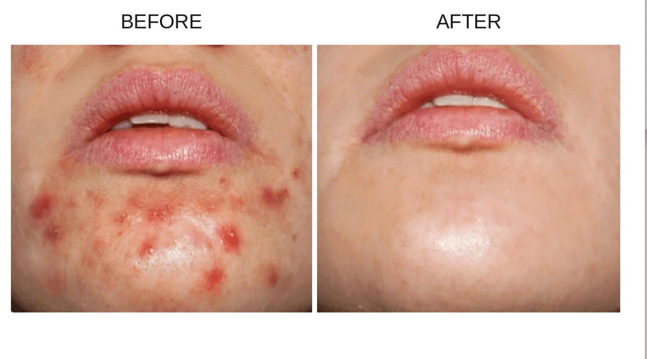Before and after comparison of a person's lower face, showing acne and redness on the left side labeled BEFORE, and clearer, smoother skin on the right side labeled AFTER. Results after using The Nutrient o Supplements