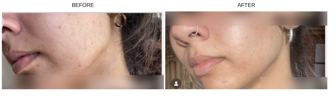 Before and after close-up facial skin comparison of a person, showing skin texture and blemishes on the cheek and jawline. Results after using The Nutrient Co Supplements