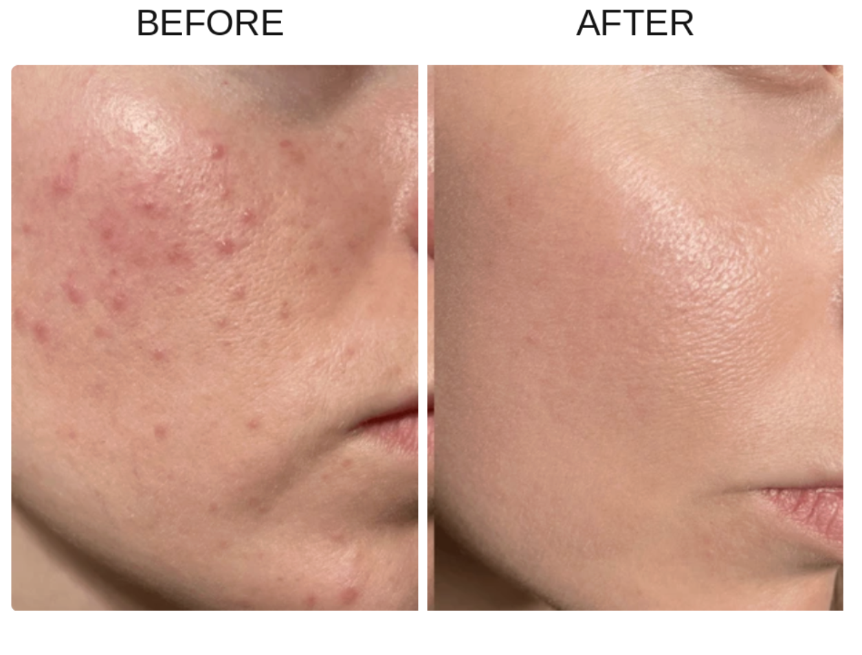 Before and after close-up comparison of a person's cheek, showing acne and redness on the left panel and clearer, smoother skin on the right panel. Results after using The Nutrient Co Supplements