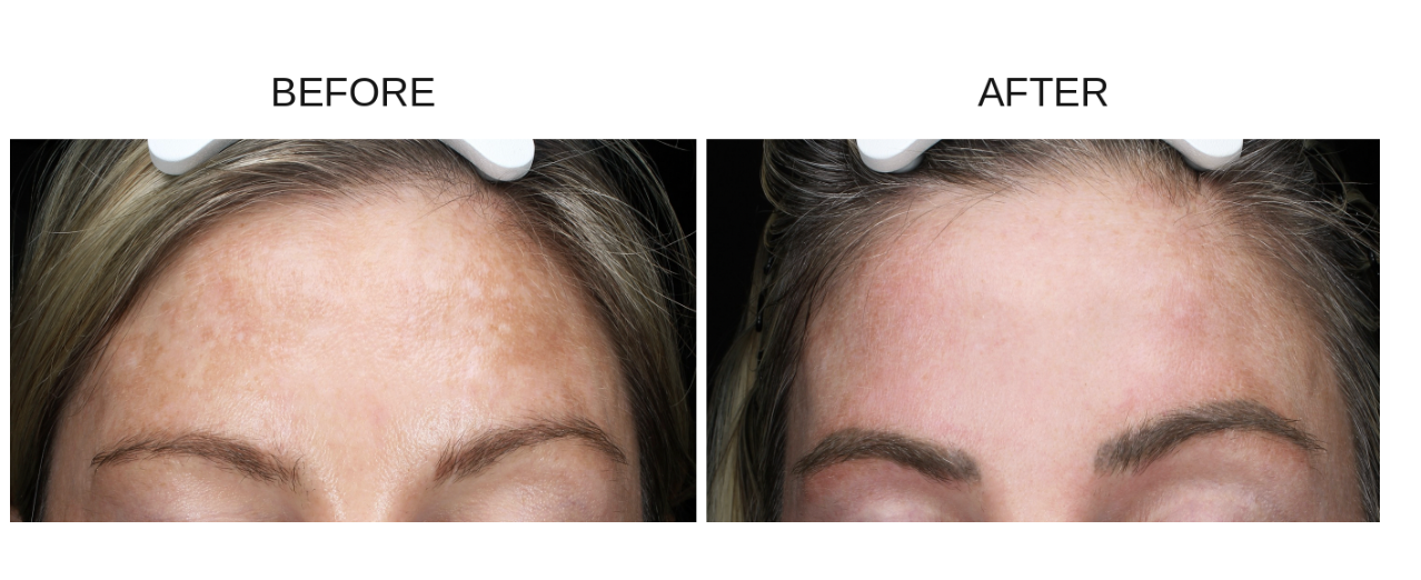 A side-by-side before and after comparison of a woman's forehead showing skin texture and texture improvement, with the text 'BEFORE' and 'AFTER' above each panel. Results after using The Nutrient Co Supplements