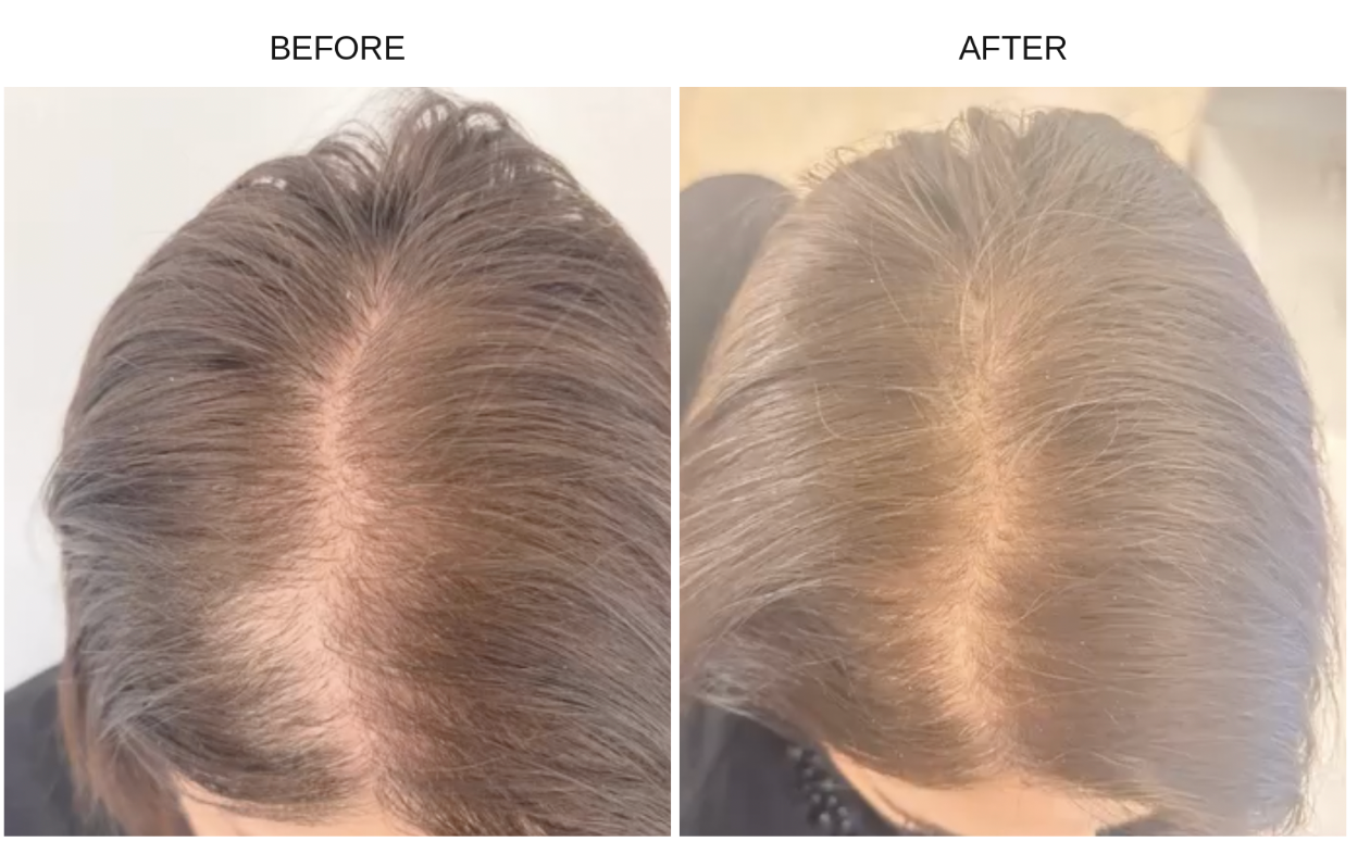 A side-by-side before and after comparison showing the top of a person's head, focusing on hair density and part visibility. Results after using The Nutrient Co Supplement. The left panel is labeled BEFORE and shows a fuller-looking hairline and part; the right panel is labeled AFTER and shows a thinner, more receding hairline.